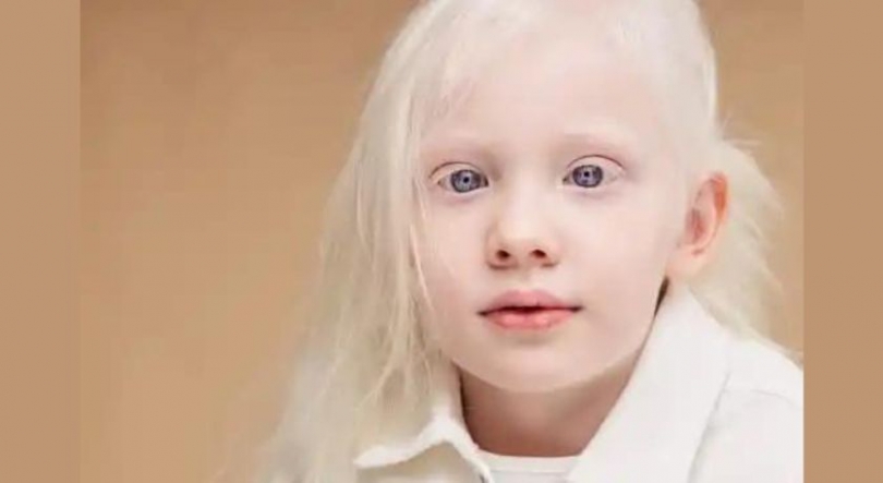 Imagem de Comunidade albina moçambicana diz ser alvo de discriminação