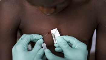 Imagem de Autoridades de Lunda Norte negam casos de varíola dos macacos após rumores nas redes sociais