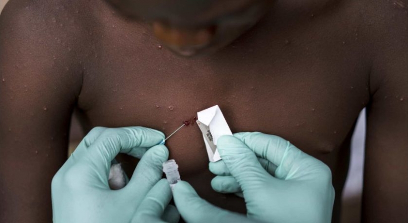 Imagem de Autoridades de Lunda Norte negam casos de varíola dos macacos após rumores nas redes sociais