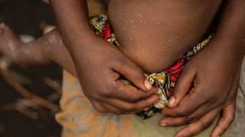 Imagem de Angola registou 184 casos de Mpox entre 6 de julho e 16 de agosto