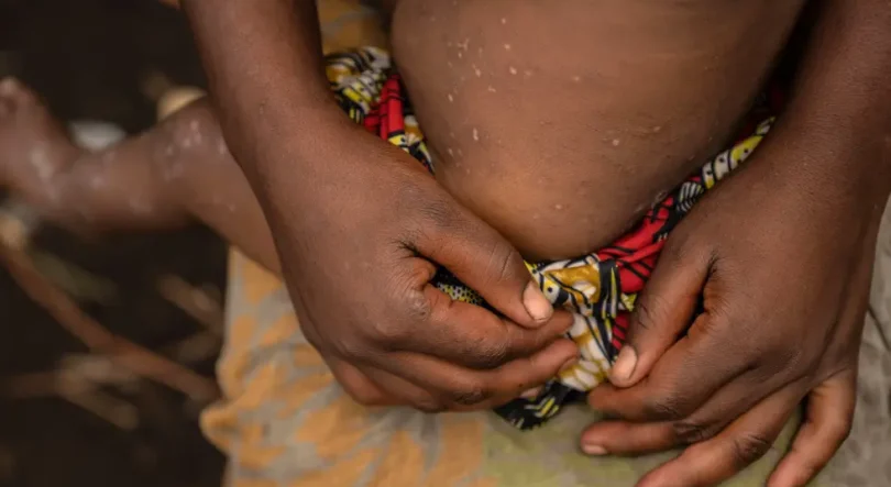 Imagem de Angola registou 184 casos de Mpox entre 6 de julho e 16 de agosto