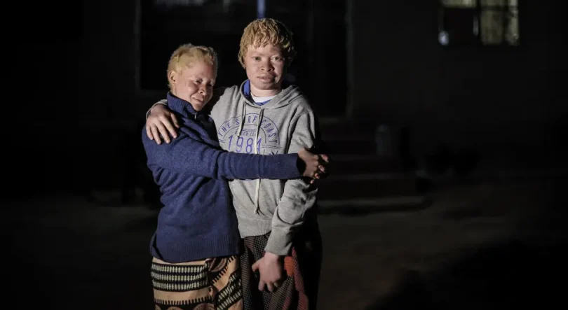 Imagem de Albinos com dificuldades em Moçambique